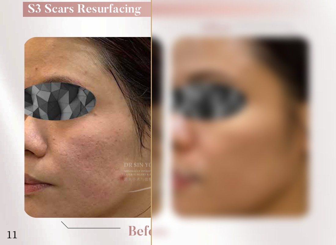 S3 Resurfacing Lift Laser — Scars Resurfacing — Atelier Aesthetics, CityLink Mall Singapore