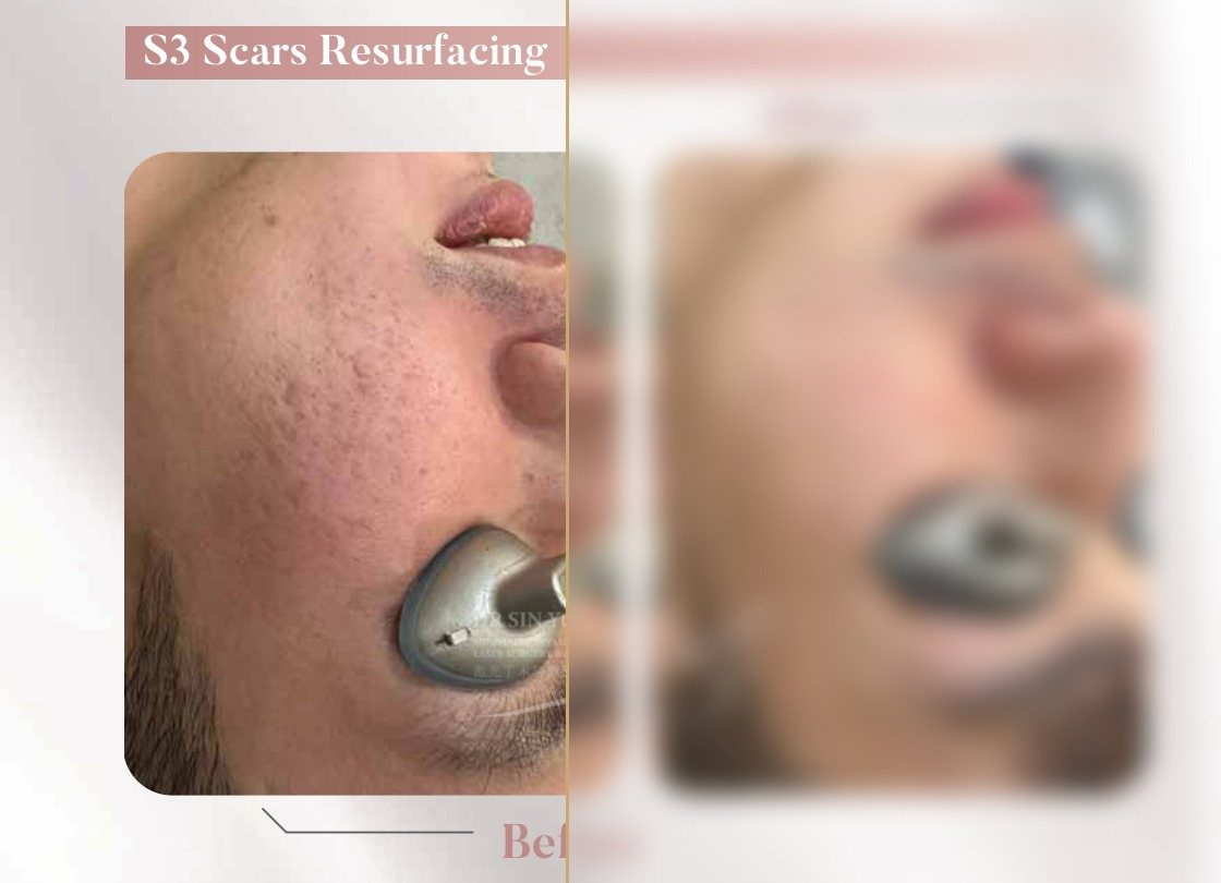 S3 Resurfacing Lift Laser — Scars Resurfacing — Atelier Aesthetics, CityLink Mall Singapore