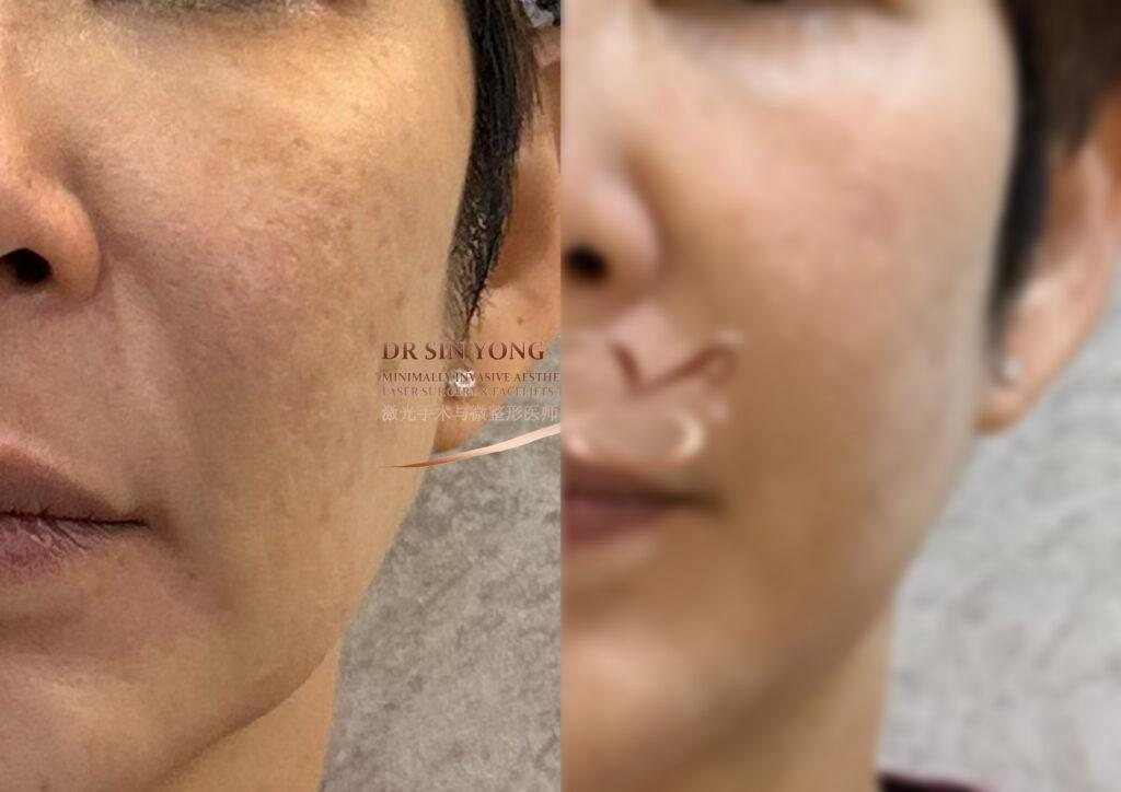 FSX Flawless Smooth Laser — Pores & Melasma — Atelier Aesthetics, CityLink Mall Singapore