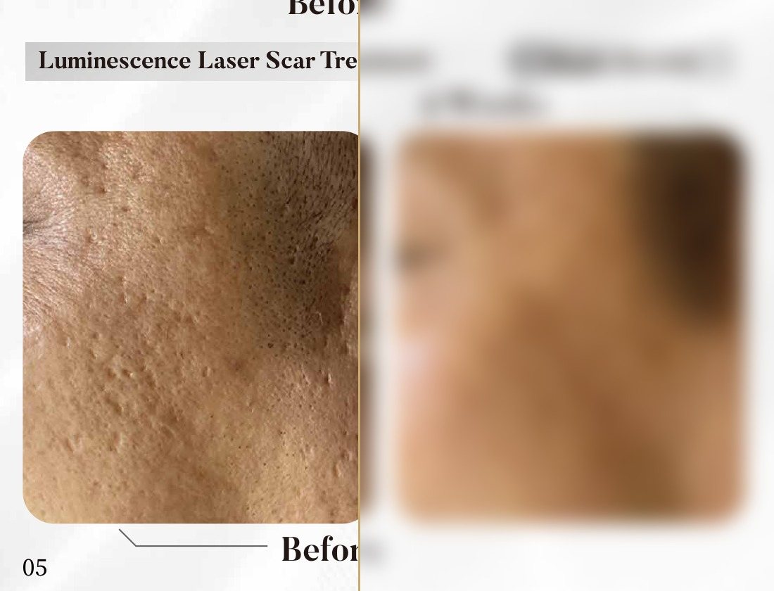 Luminescence Laser — Scar Treatment, 4 Weeks (Single Session) — Atelier Aesthetics, CityLink Mall Singapore