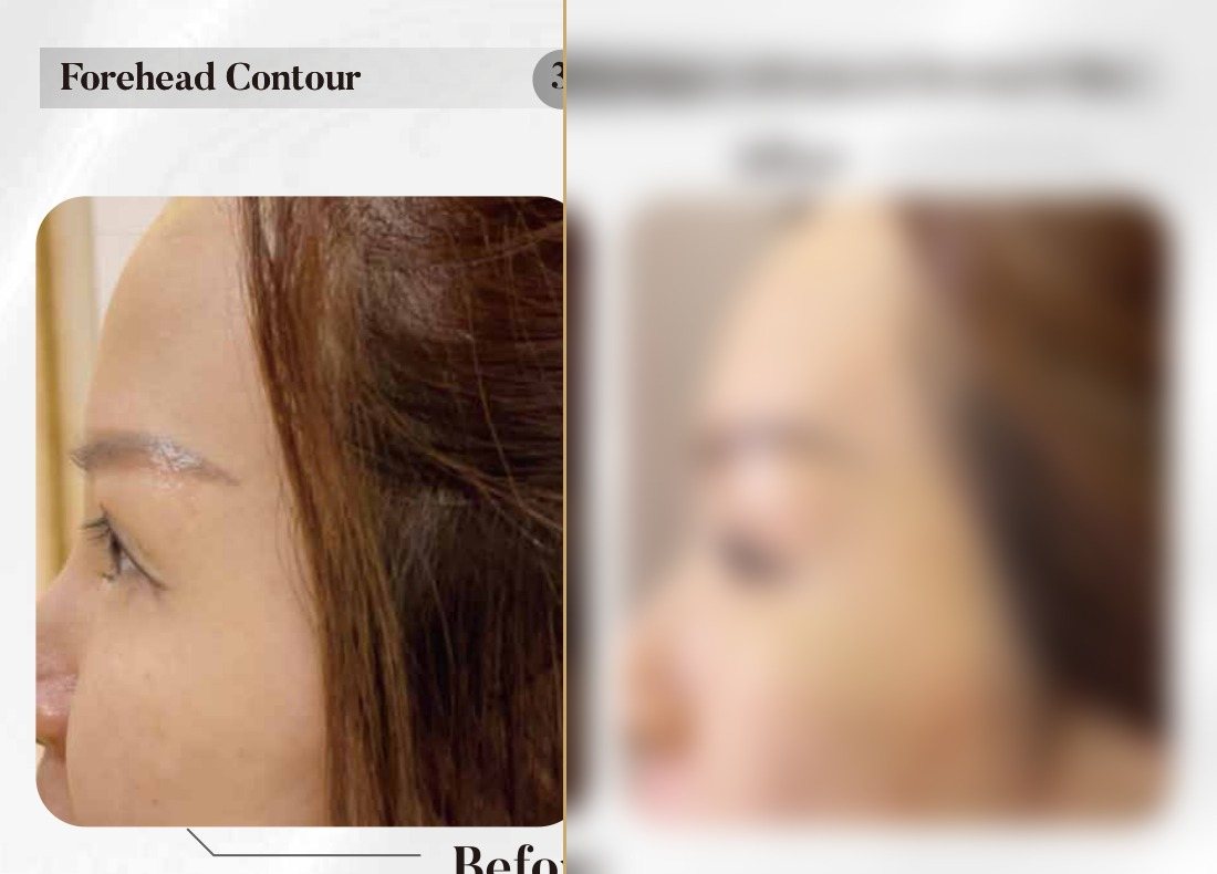 Dermal Filler — Forehead Contour (3 Syringes) — Atelier Aesthetics, CityLink Mall Singapore