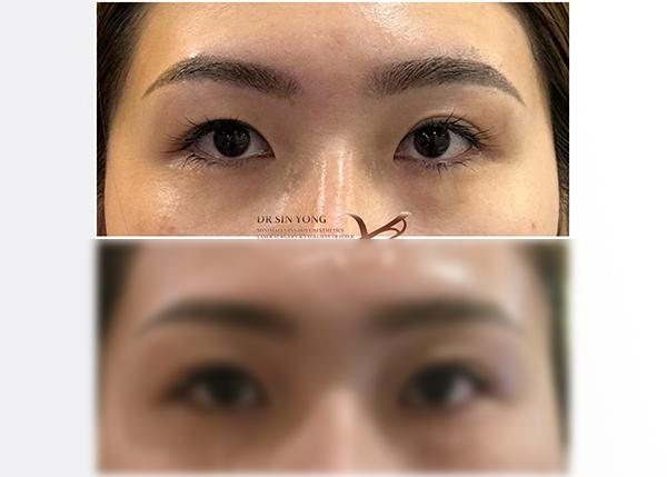 FSX Flawless Smooth Laser — Non Surgical Eye Lift for Droopy Eyelids — Atelier Aesthetics, CityLink Mall Singapore