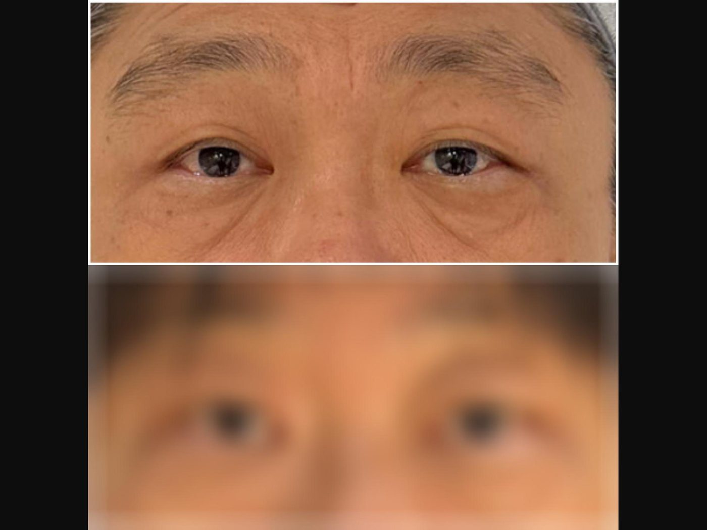 VF Periorbital Eyelift - Lifts Droopy Eyelids — Atelier Aesthetics, CityLink Mall Singapore