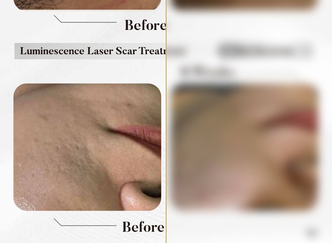 Luminescence Laser — Scar Treatment, 8 Weeks (Two Sessions) — Atelier Aesthetics, CityLink Mall Singapore