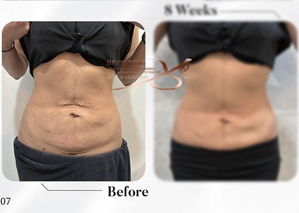 Luminescence Tummy Loose Skin Lift — Atelier Aesthetics, CityLink Mall Singapore