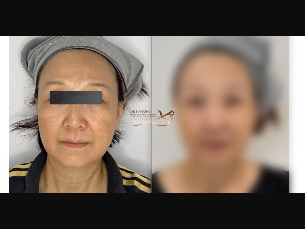 FSX Flawless Smooth Laser — Lifting & Melasma — Atelier Aesthetics, CityLink Mall Singapore