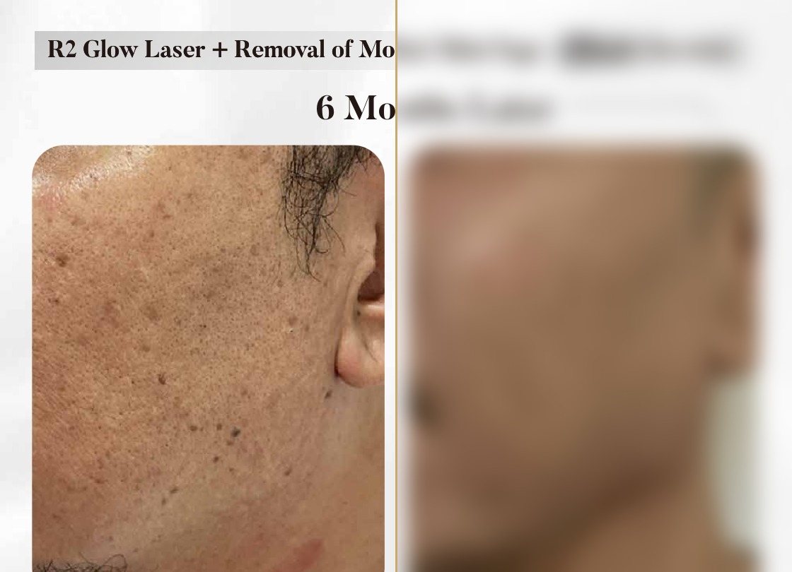R2 Glow Laser + Mole/Skin Tag Removal — 6 Months Later (Single Session) — Atelier Aesthetics, CityLink Mall Singapore