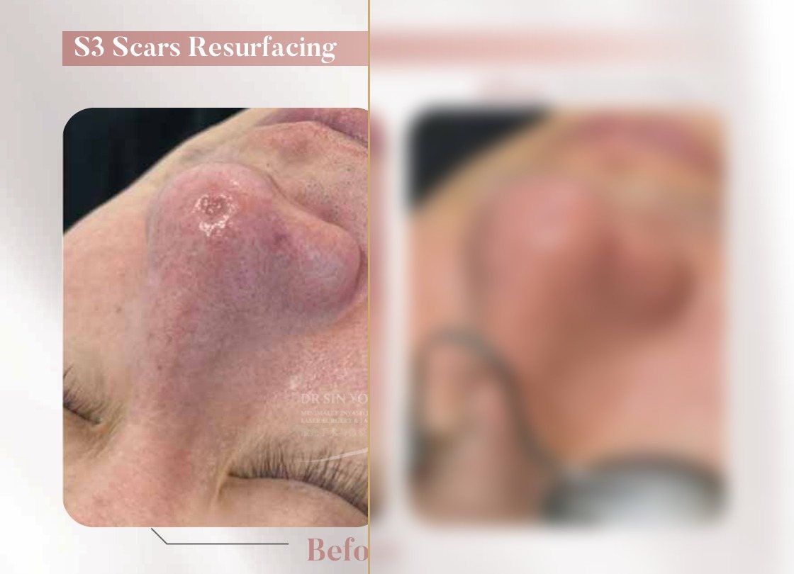 S3 Resurfacing Lift Laser — Scars Resurfacing — Atelier Aesthetics, CityLink Mall Singapore