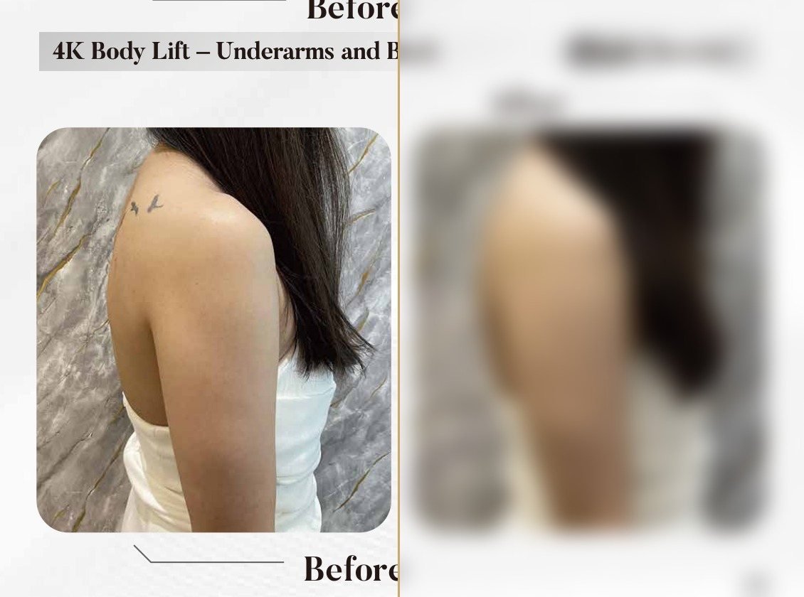 4K Body Lift — Underarms & Back (Single Session) — Atelier Aesthetics, CityLink Mall Singapore