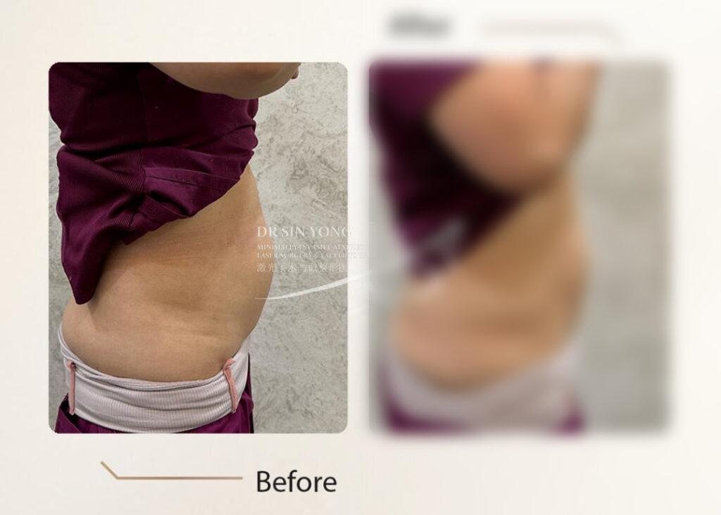 4K Body Lift — Tummy Contouring — Atelier Aesthetics, CityLink Mall Singapore