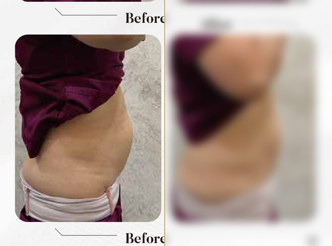 4K Body Lift — Upper & Lower Tummy Side View (Single Session) — Atelier Aesthetics, CityLink Mall Singapore