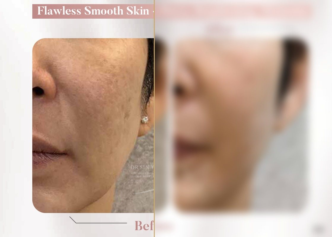 FSX Laser — Pores, Brightening & Melasma — Atelier Aesthetics, CityLink Mall Singapore