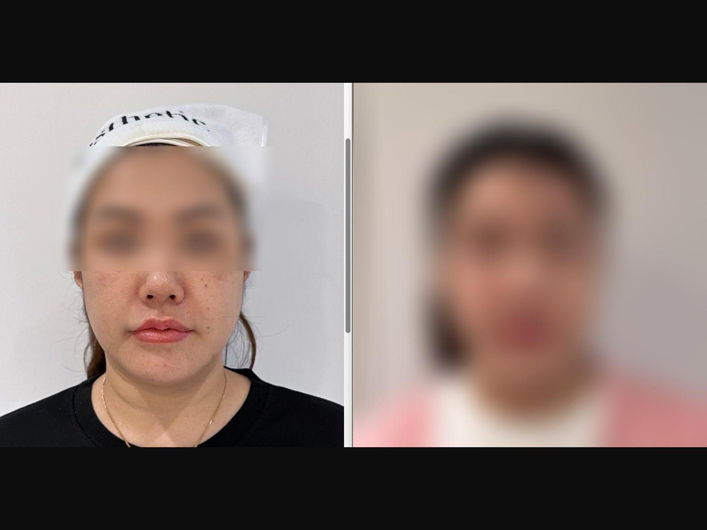 VF Facelift - Lifts Nasolabial Folds Jowls Double Chin 3 — Atelier Aesthetics, CityLink Mall Singapore