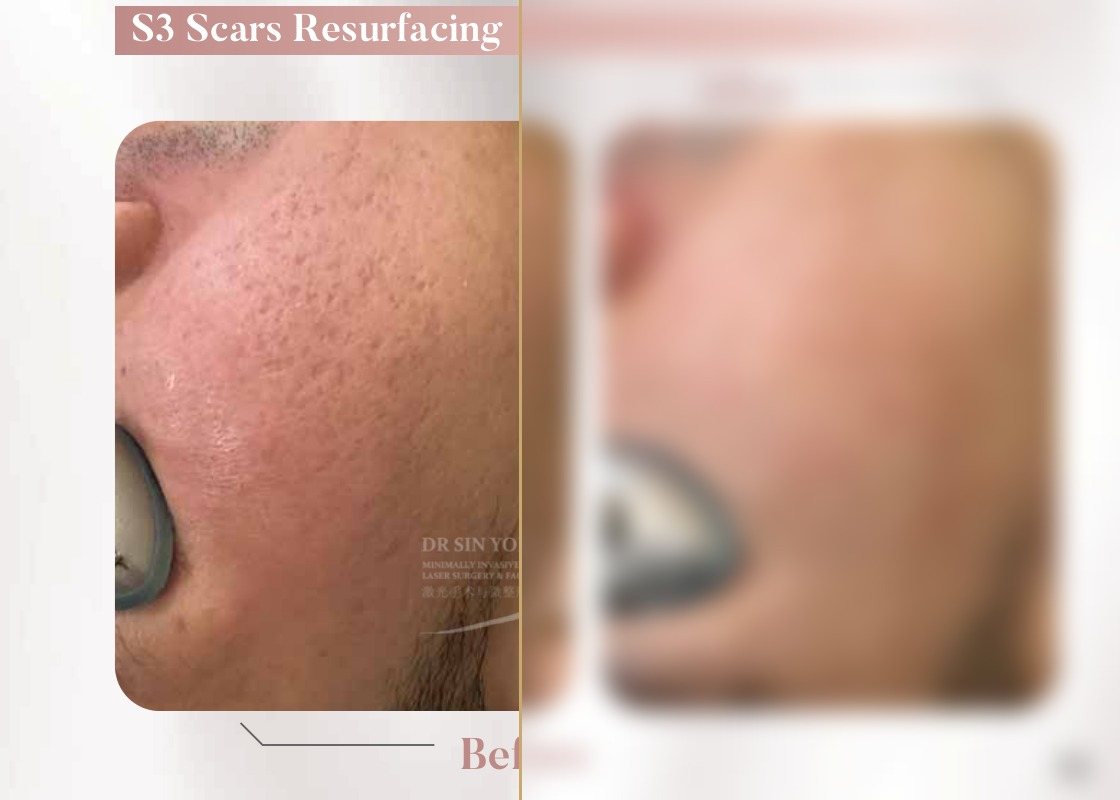 S3 Resurfacing Lift Laser — Scars Resurfacing — Atelier Aesthetics, CityLink Mall Singapore