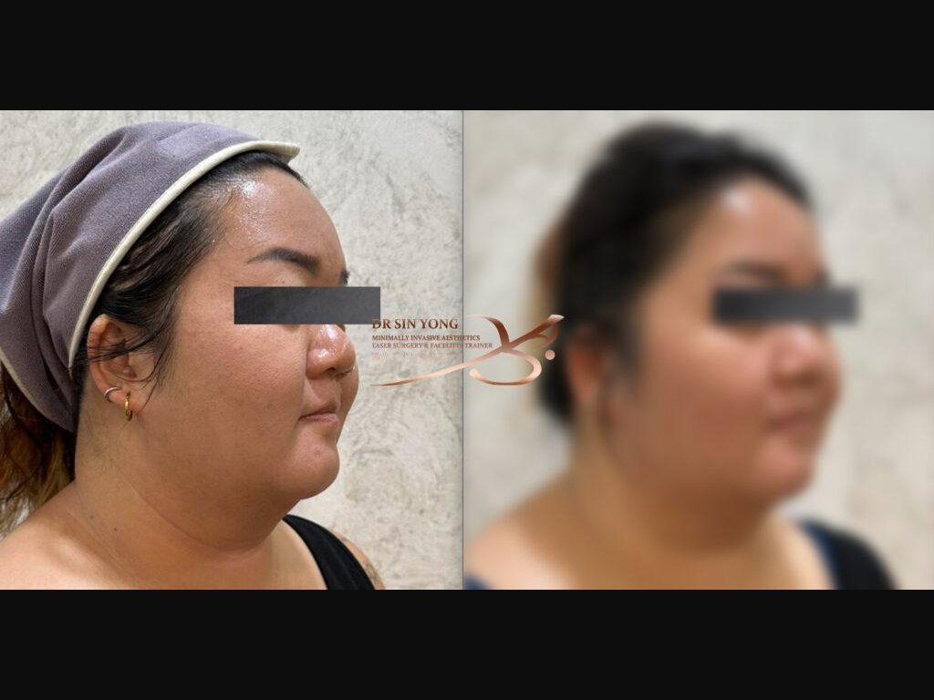 Tetra Pro Scar3 — Face Lift Treatment — Atelier Aesthetics, CityLink Mall Singapore